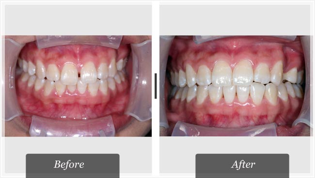 how does invisalign work paperwingrvice web fc2 com how does invisalign work