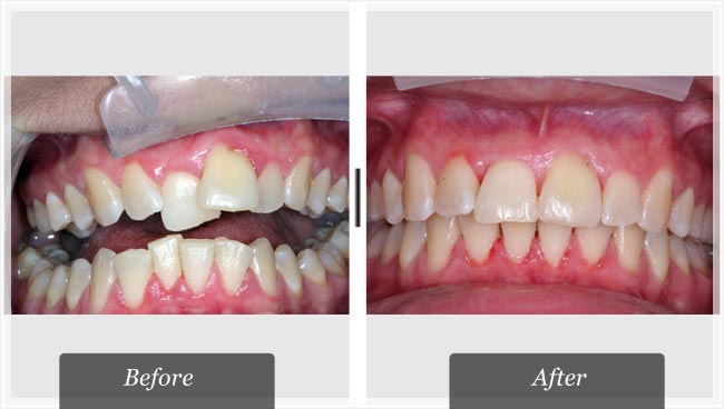 clear braces or invisalign