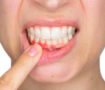Gum Disease Treatments in Wichita Ks - Gum Disease Early ...
