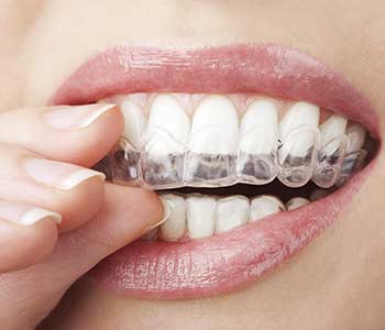 How Invisalign Works for You in Wichita KS area