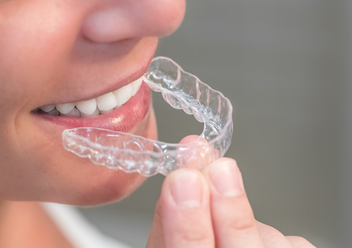 Invisible Braces for Teeth in Wichita KS Area