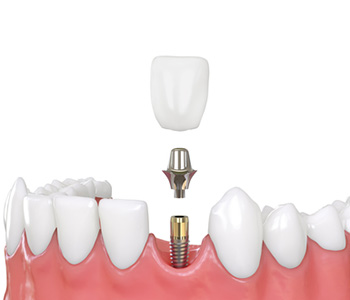 Mini Dental Implants in Wichita area
