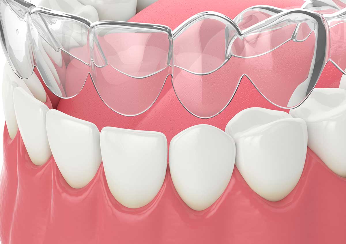 Straight Wire Orthodontics in Wichita, KS Area