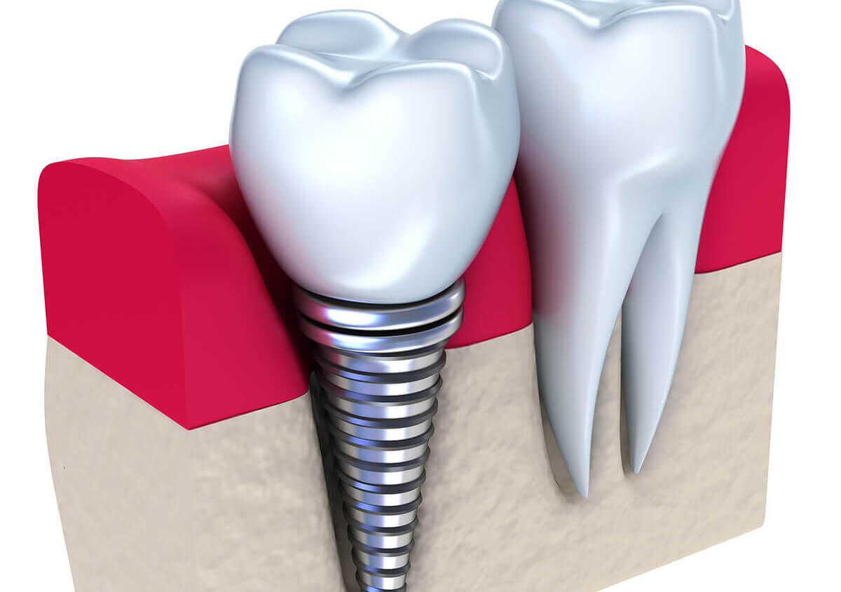 Teeth Implants Dentist in Wichita KS Area