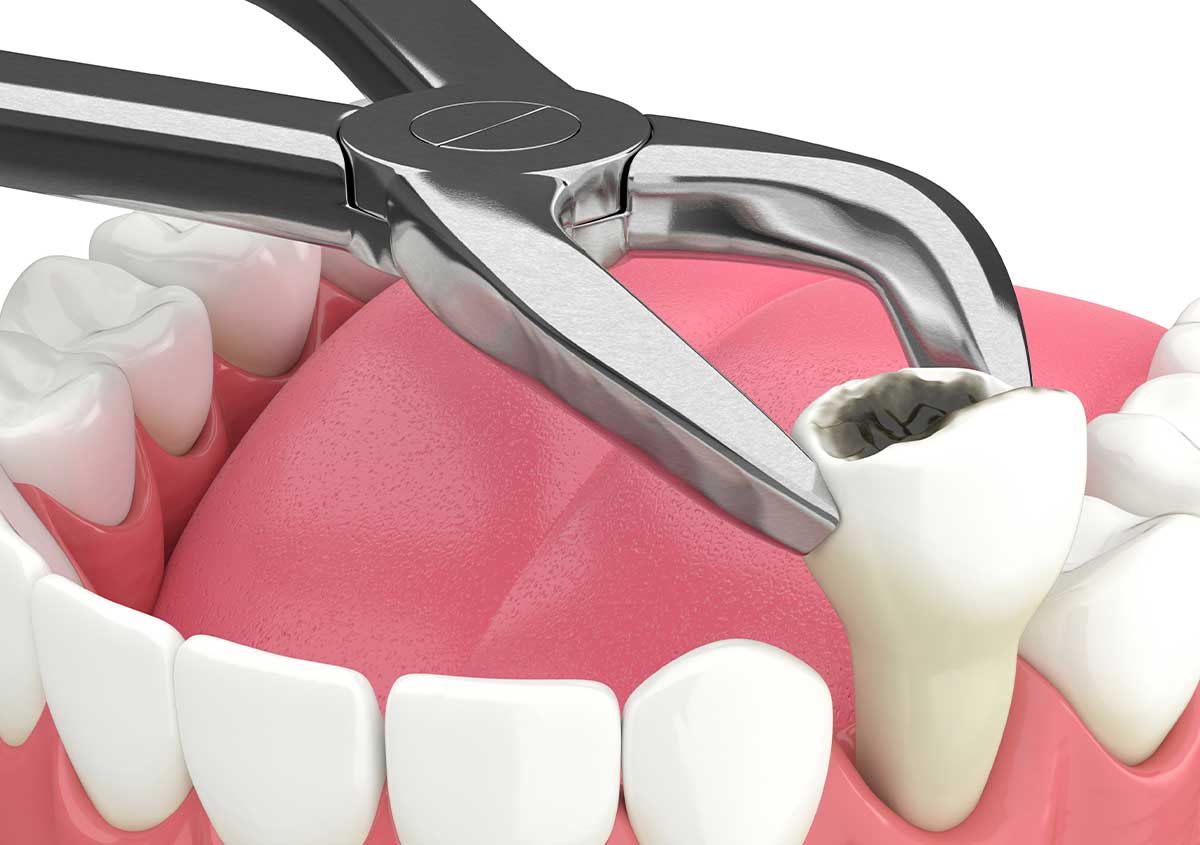 Wisdom Teeth Removal in Wichita KS Area