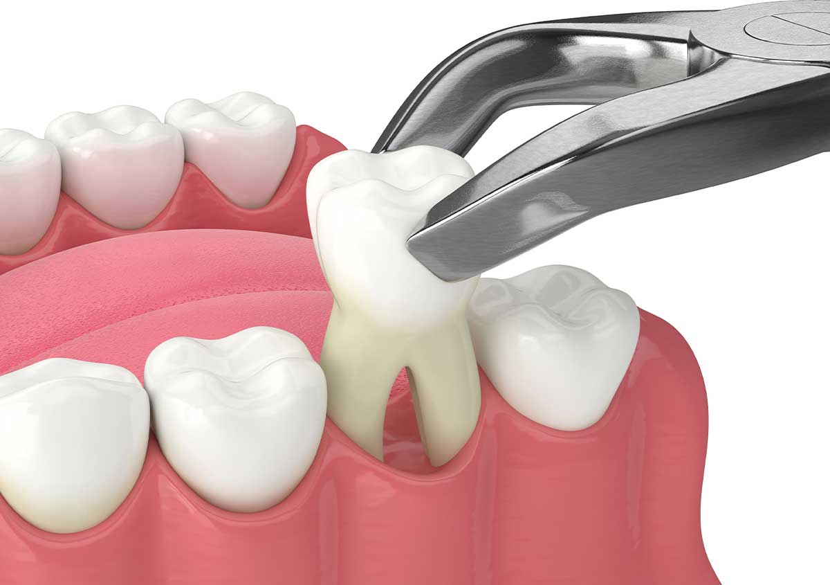 Wisdom Tooth Extractions in Wichita, KS
Area